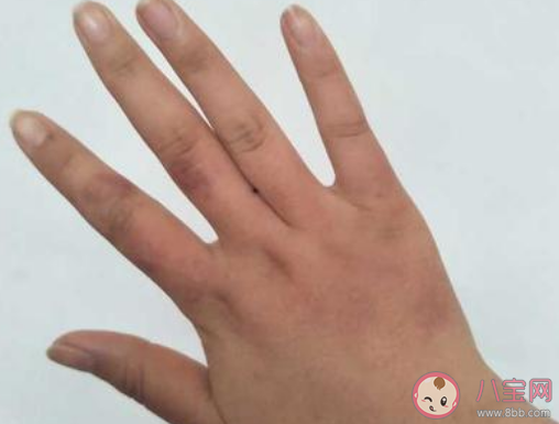 用醋能不能治療凍瘡 臉部凍瘡是怎么回事 用醋能不能治療凍瘡 臉部凍瘡是怎么回事