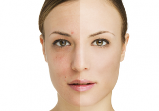 臉上長黃褐斑是皮膚早衰了嗎 黃褐斑的正規(guī)治療方法是什么