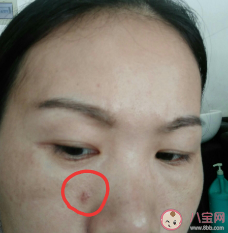 點痣后還能不能敷面膜 點痣了多久能擦護膚品