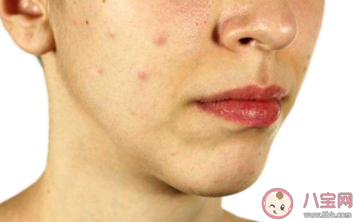 床上螨蟲咬了會有什么癥狀 被螨蟲咬了怎么辦 