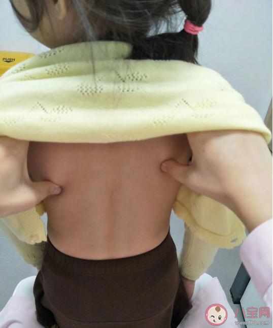 脊柱彎曲納入全國學生常見病監(jiān)測 怎么及早發(fā)現(xiàn)孩子脊柱側(cè)彎