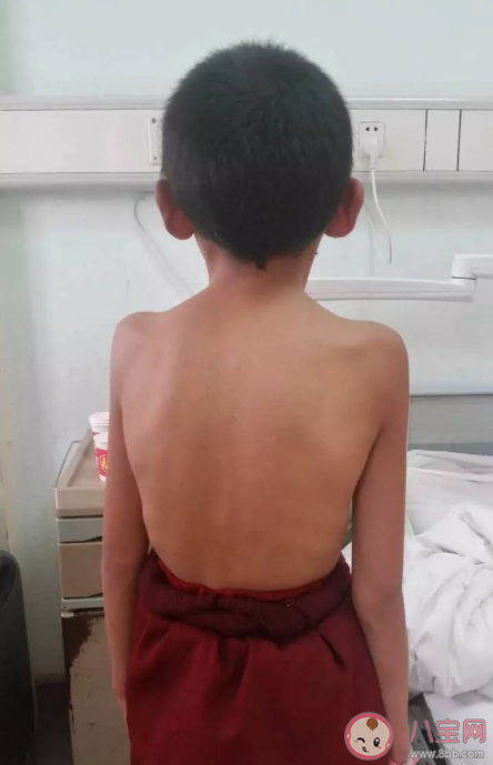 脊柱彎曲納入全國學生常見病監(jiān)測 怎么及早發(fā)現(xiàn)孩子脊柱側(cè)彎