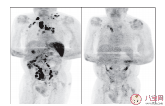 新冠病毒能消滅腫瘤嗎 可以選擇感染新冠病毒來治療腫瘤嗎