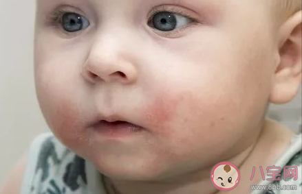 寶寶的臉上有一團團白色的東西是什么 兒童白色糠疹怎么治療最有效