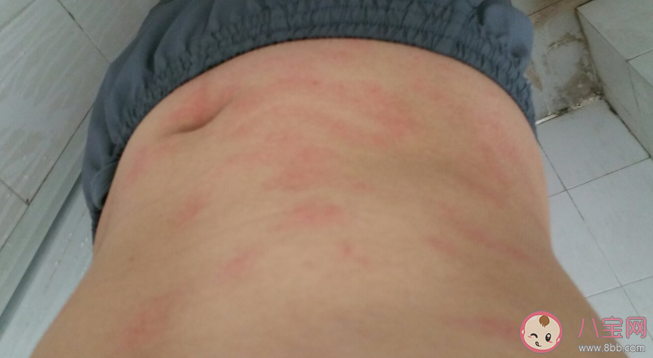 過敏性皮炎用什么藥好 過敏性皮炎患者如何做好生活管理