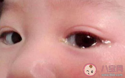 為什么春季孩子容易上火 春季孩子上火怎么辦