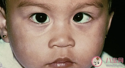 孩子弱視怎么及時發現 弱視如何治療