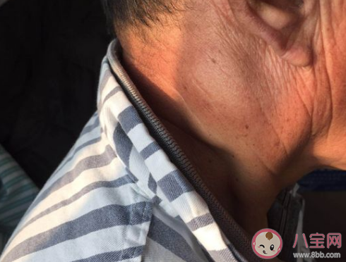 耳朵后面長了個包一按就疼怎么回事 耳朵后面長包怎么辦