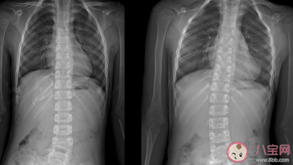 孩子脊柱側彎是什么原因造成的 脊柱側彎有哪些影響 孩子脊柱側彎是什么原因造成的 脊柱側彎有哪些影響