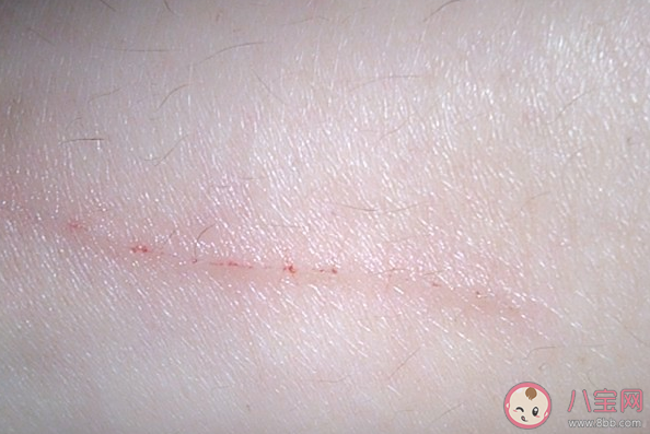 被寵物抓傷要打狂犬疫苗嗎 接種狂犬疫苗這些應(yīng)該知道 被寵物抓傷要打狂犬疫苗嗎 接種狂犬疫苗這些應(yīng)該知道