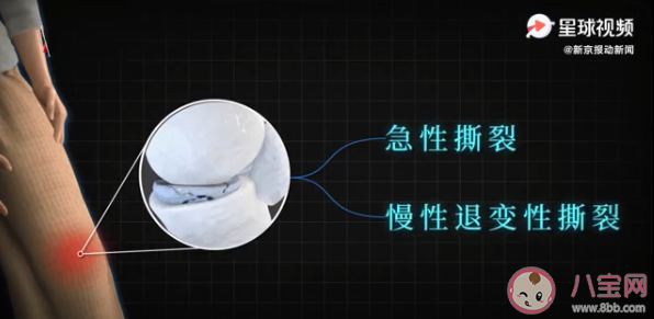 年輕人成半月板損傷主要人群是怎么回事 如何保護半月板避免受傷 年輕人成半月板損傷主要人群是怎么回事 如何保護半月板避免受傷