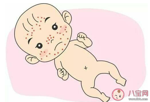 怎樣鑒別新生兒面皰和濕疹 面皰和濕疹具體區別是什么