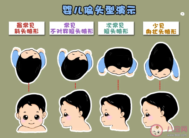 寶寶偏頭會影響視力發育是真的嗎 寶寶偏頭長大了會自然好嗎