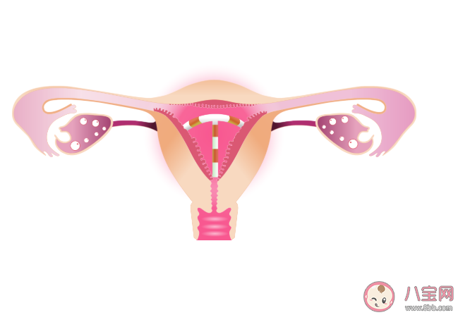 節(jié)育環(huán)不及時(shí)取出有什么危害 節(jié)育環(huán)一直不取對身體有什么影響