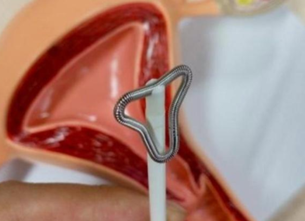 節育環取環過程是怎樣的 取環要打消炎針嗎