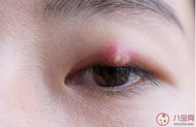 長了麥粒腫可以自己擠破嗎 長了麥粒腫怎么應對處理