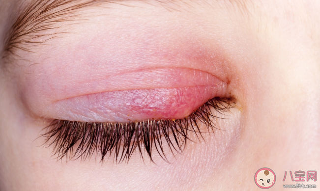 長了麥粒腫可以自己擠破嗎 長了麥粒腫怎么應對處理