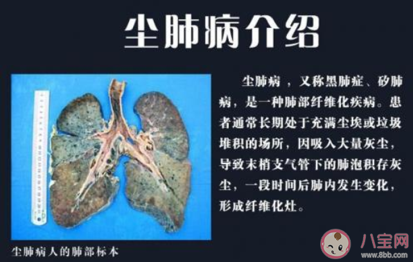 塵肺病到底有多嚴重 塵肺病如何預防 塵肺病到底有多嚴重 塵肺病如何預防