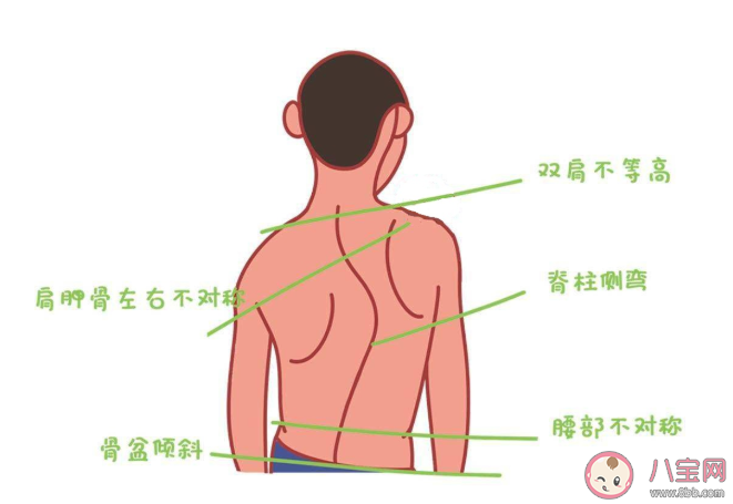 脊柱側彎可以完全復原嗎 脊柱側彎手術創傷大嗎 脊柱側彎可以完全復原嗎 脊柱側彎手術創傷大嗎
