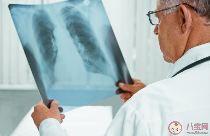 肺結節一定是肺癌嗎 發現肺結節怎么辦