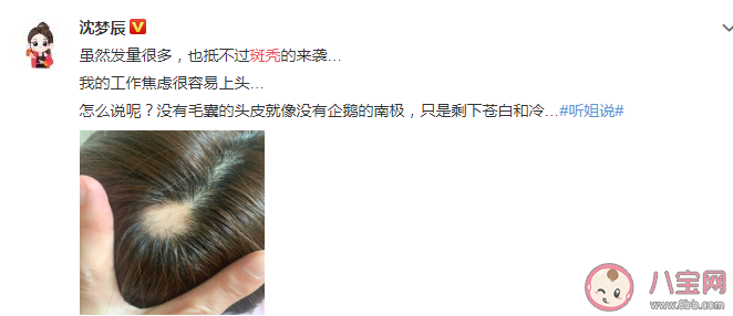 沈夢(mèng)辰自爆斑禿是怎么回事 斑禿會(huì)自己好嗎
