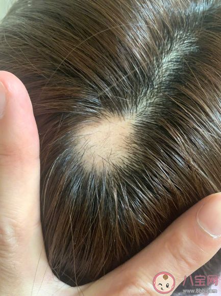 沈夢(mèng)辰自爆斑禿是怎么回事 斑禿會(huì)自己好嗎