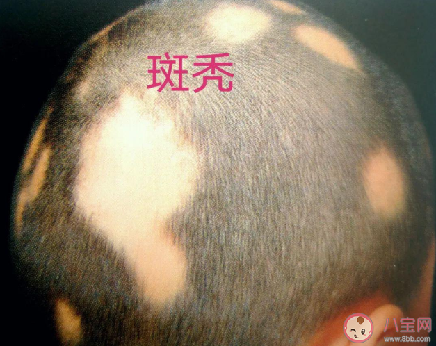 沈夢(mèng)辰自爆斑禿是怎么回事 斑禿會(huì)自己好嗎