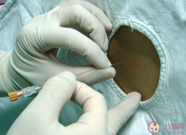 抗麻體質是什么意思 剖腹產是半麻還是全麻