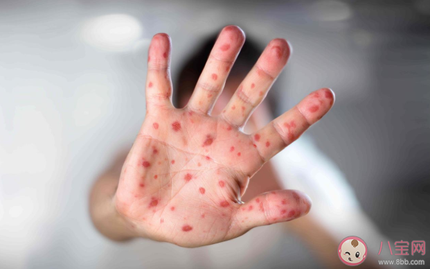 得過手足口病后還要接種疫苗嗎 EV71疫苗的保護期是多久