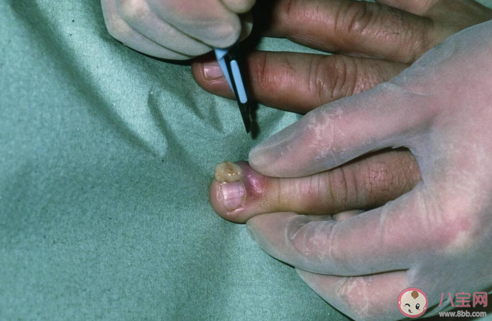 為什么總是忍不住拔倒刺 如何處理倒刺最靠譜