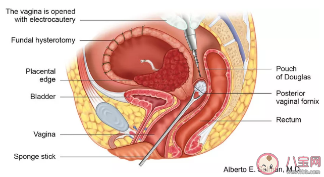 衛生棉條塞到什么位置才算放對 衛生棉條使用圖解
