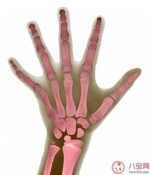 骨齡偏大需要治療嗎 骨齡偏大原因是什么