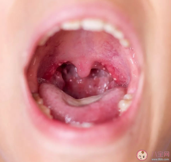 感染皰疹性咽峽炎怎么讓孩子好得快 日常如何做好預防措施