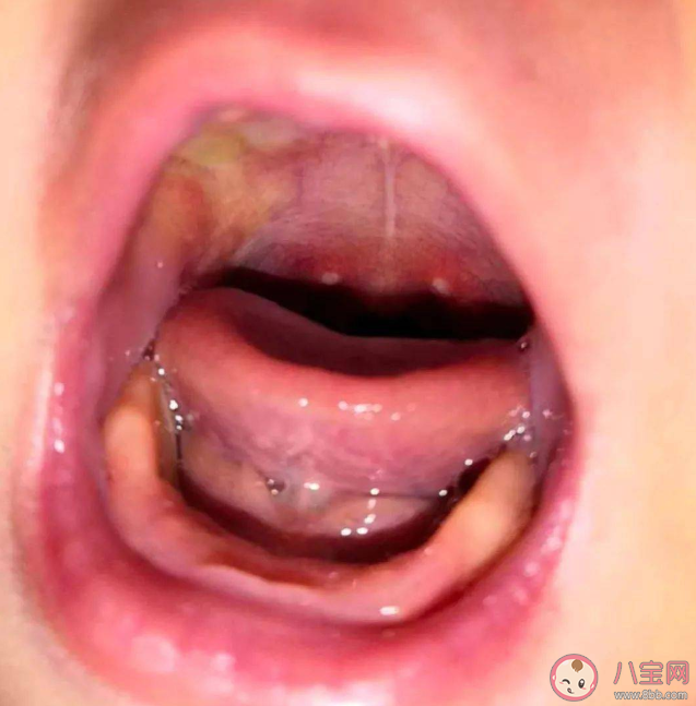 感染皰疹性咽峽炎怎么讓孩子好得快 日常如何做好預防措施