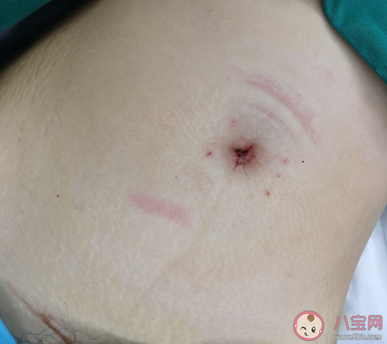 瘢痕子宮如何備孕二胎 如何避免發(fā)生瘢痕子宮