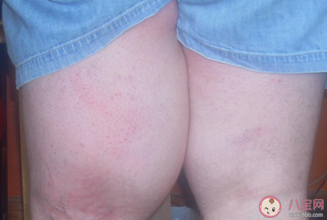 劉麗千確診粘液樣脂肪肉瘤 粘液樣脂肪肉瘤是癌嗎