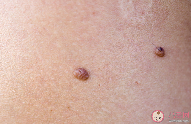 身體哪些部位上的痣一定要切除 怎么去除有問題的痣