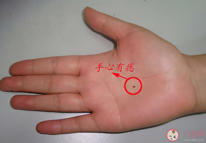 身體哪些部位上的痣一定要切除 怎么去除有問題的痣