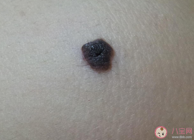 身體哪些部位上的痣一定要切除 怎么去除有問題的痣