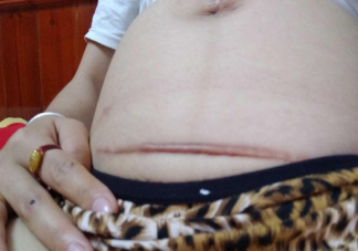 剖腹產橫切豎切怎么選 豎切和橫切哪個會更疼