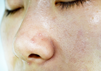 毛孔收縮水是智商稅嗎 毛孔粗大問題怎么解決