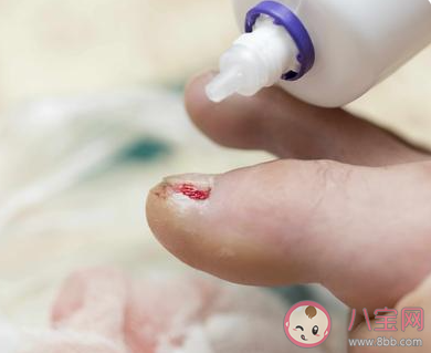 甲溝炎是怎樣造成的 為什么會得甲溝炎