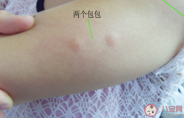 哪3類人最吸引蚊子 被蚊子叮咬后怎么止癢防感染