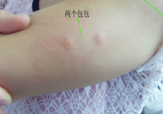 哪3類人最吸引蚊子 被蚊子叮咬后怎么止癢防感染