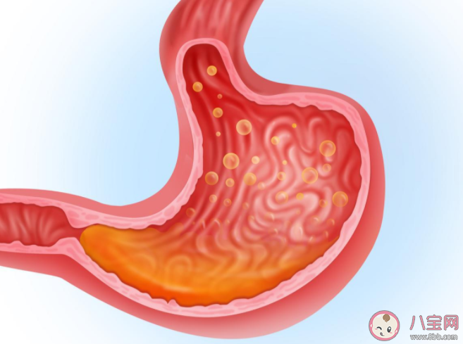 反流性食管炎有什么癥狀 反流食管炎飲食上有什么建議