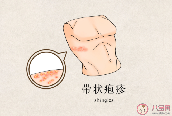 帶狀皰疹水泡可以戳破嗎 帶狀皰疹有多折磨人 帶狀皰疹水泡可以戳破嗎 帶狀皰疹有多折磨人