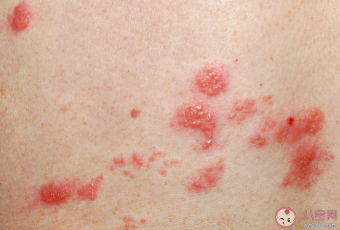 帶狀皰疹水泡可以戳破嗎 帶狀皰疹有多折磨人 帶狀皰疹水泡可以戳破嗎 帶狀皰疹有多折磨人