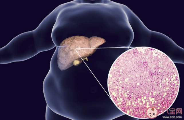 堅(jiān)持不吃肉脂肪肝就能好嗎 脂肪肝吃肉哪些方面要控制好