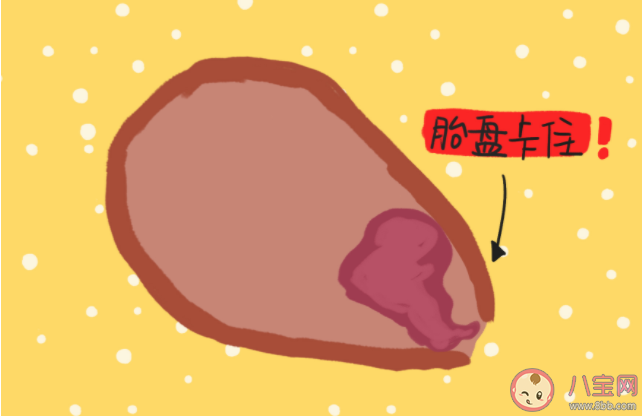 產婦出現什么情況需要經歷手剝胎盤 如何預防胎盤滯留發生