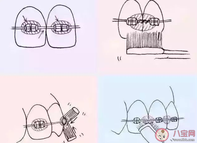 正畸戴牙套用什么清潔牙齒 ?戴牙套清潔牙齒要注意什么 正畸戴牙套用什么清潔牙齒 ?戴牙套清潔牙齒要注意什么